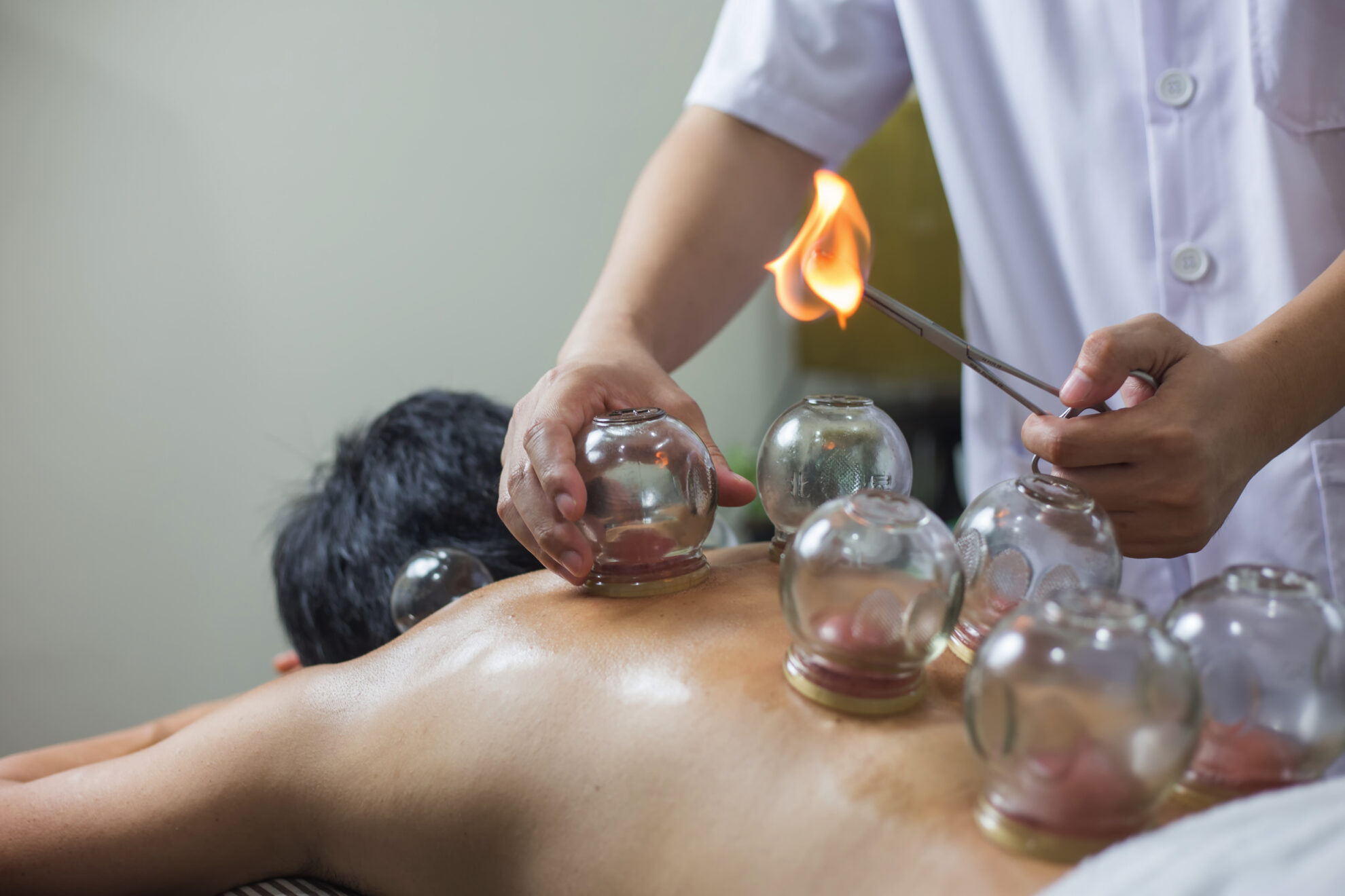 TCM_Kurdirekt Therapeut mit Feuer behandelt Rücken einer Person zum Schröpfen während TCM-Anwendung